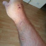 An injured samoyed owner after a pitbull attack